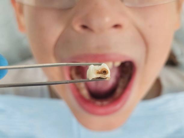 Best Emergency Treatment for Toothache in Shady Shores, TX